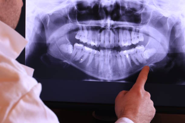 Best Emergency Treatment for Dental Infections or Abscesses in Staples, MN