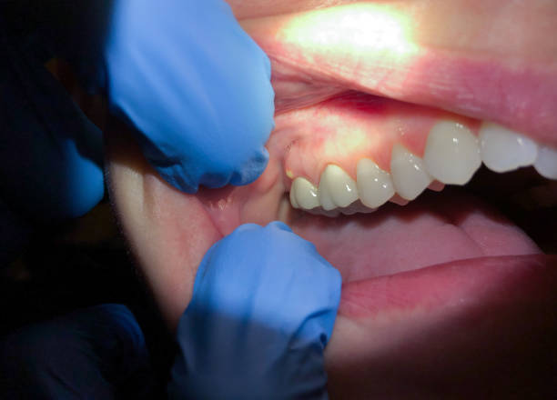 Best Emergency Dental Care for Broken or Chipped Teeth in Staples, MN