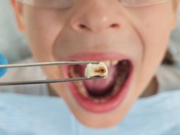 Best Emergency Gum Treatment in Staples, MN